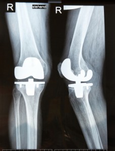Artificial Knees
