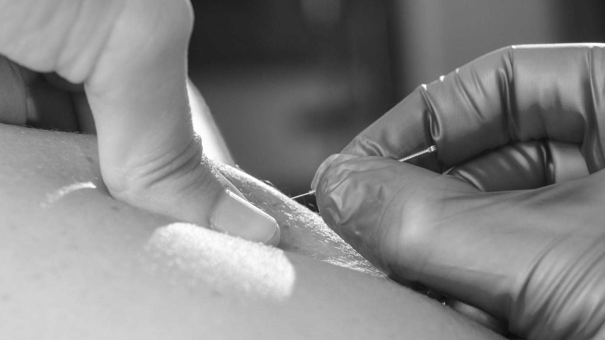 Dry Needling / Intramuscular Stimulation (IMS)​ - Trifecta Rehab